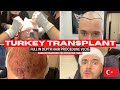 Turkey hair transplant  fue procedure vlog at hair of istanbul  4400 grafts hairtransplant