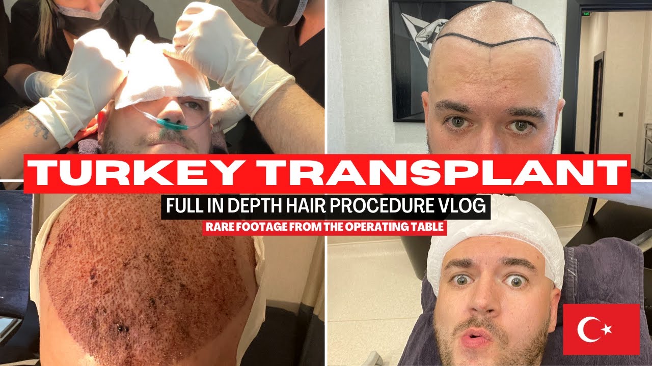 Пересадка волос в Турции — видеоблог о процедуре FUE в клинике Hair of Istanbul — 4400 графтов #H...