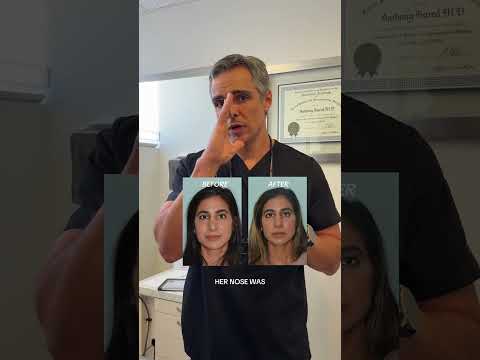 Video thumbnail: Results of a congenital nasal deformity case | Anthony Bared M.D, FACS | Miami, FL · Dr. Anthony Bared, M.D - Facial Plastic Surgeon