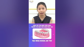 Tìm lại nụ cười tự tin với PP niềng răng mắc cài|NK AN TRÍ #shorts #niengrangmaccai #nhakhoaantri