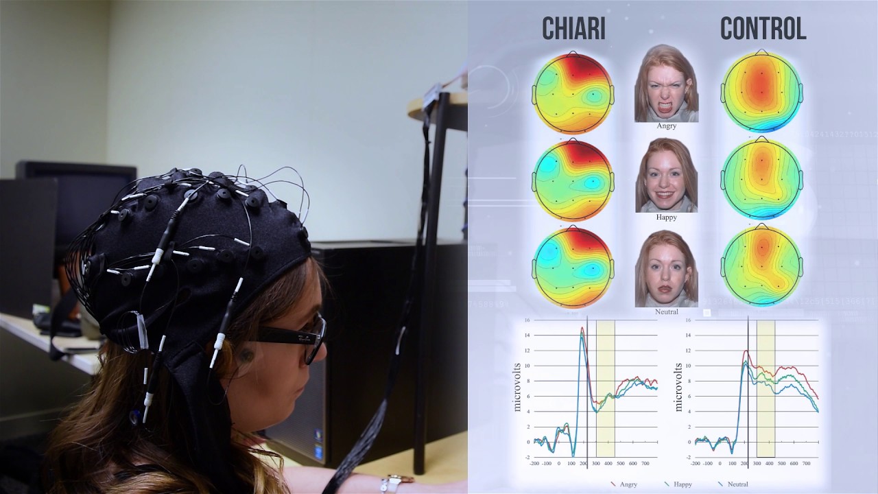 Cognitive Function & Chiari