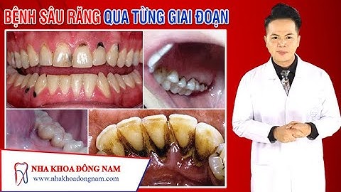 Hiểu Rõ Về Bệnh Sâu Răng Qua Từng Giai Đoạn | NHA KHOA ĐÔNG NAM®