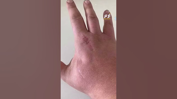 عضة قطة تنهي حياة رجل.. فكيف حدث ذلك؟