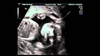 18w6d