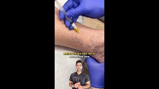 Watch a Varicose Vein Collapse Instantly