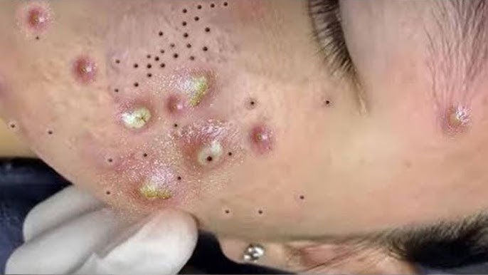 Big Cystic Acne Blackheads Extraction Blackheads & Milia, Whiteheads  Removal Pimple Popping # 3766 - YouTube