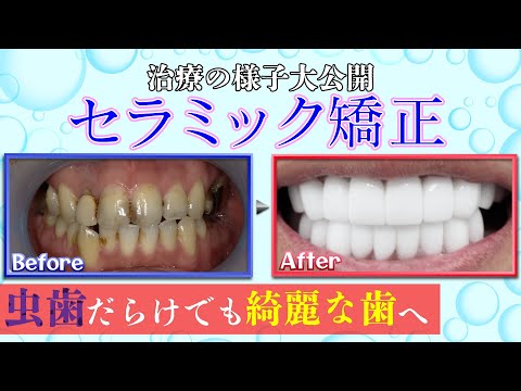 【セラミック歯】全身麻酔治療で綺麗な歯に短期間で生まれ変わる！【矯正】