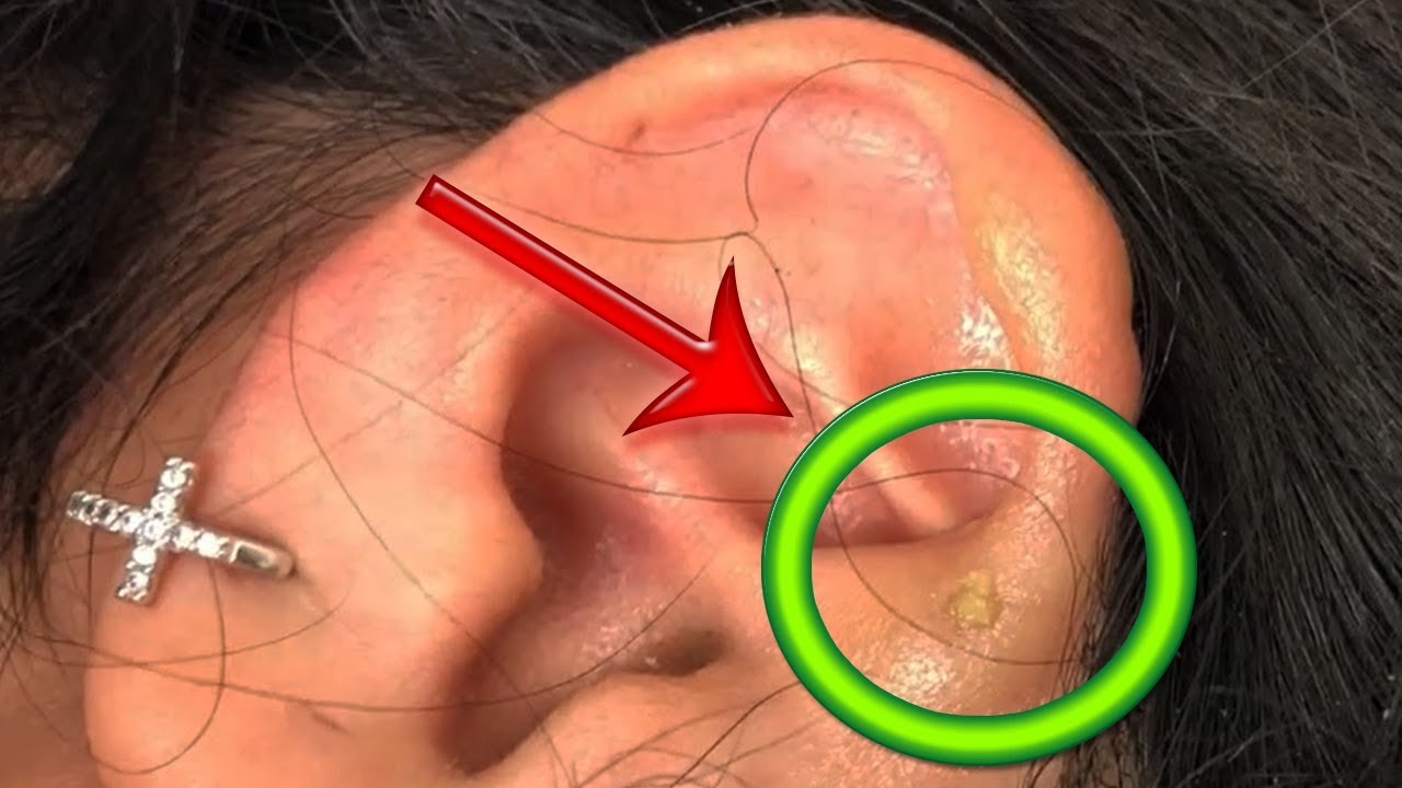 Ear Blackheads & Pimples? One Little Pop YouTube