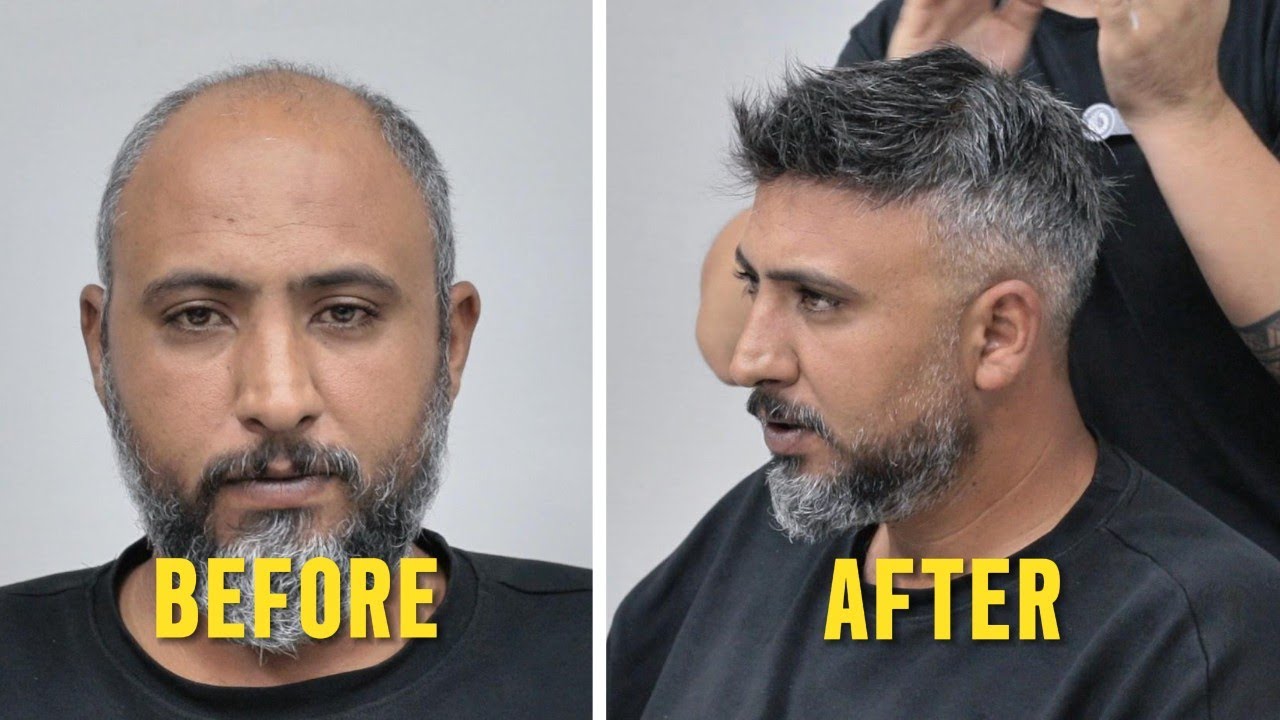 BEYAZLI PROTEZ SAÇ UYGULAMASI - HAIR REPLACEMENT