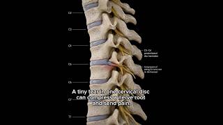 The Neck Injury That Can Steal Strength From Your Arms | Cervical Disc Herniation