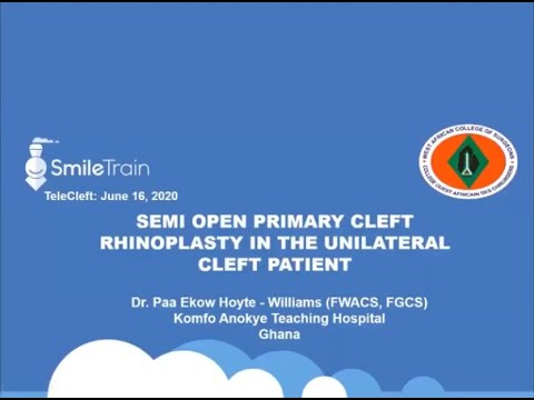 Video thumbnail: Cleft Rhinoplasty/Nose Revision | Dr. Hoyte-Williams | Telecleft Lecture | Smile Train & WACS — Smile Train Programs