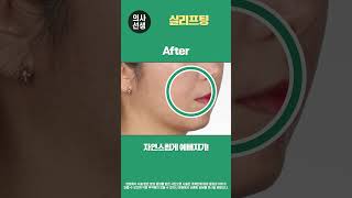연신내피부과 ✌실리프팅 전/후