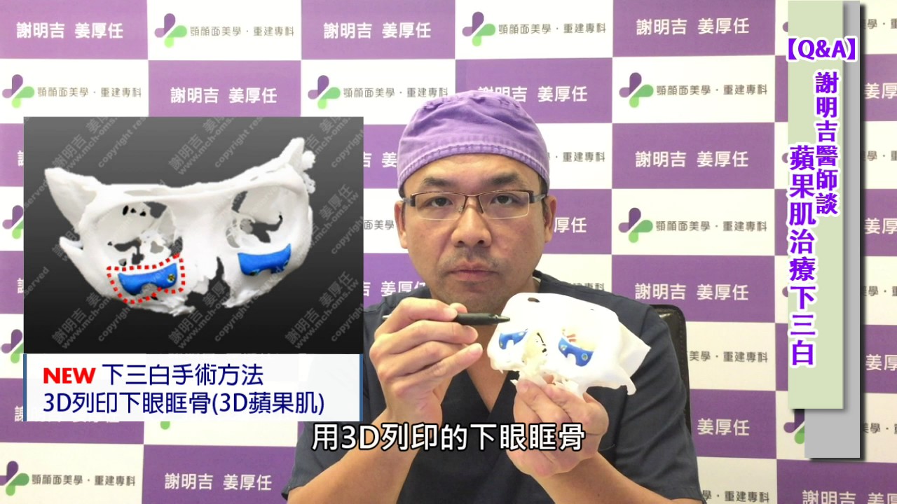 填蘋果肌 謝明吉談3d蘋果肌植入手術 矯正下三白及淚溝 謝明吉 姜厚任 顎顏面美學重建專科診所 風華聯合診所