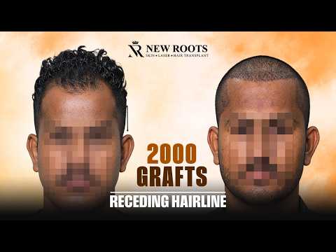 Rebuilding a Receding Hairline With 2000 Grafts! 🤯 | Hair Transplant in Mumbai | Cost & Best Results