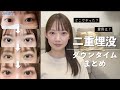 【二重埋没】ダウンタイムの様子全て見せます！10年間のアイプチ卒業👀