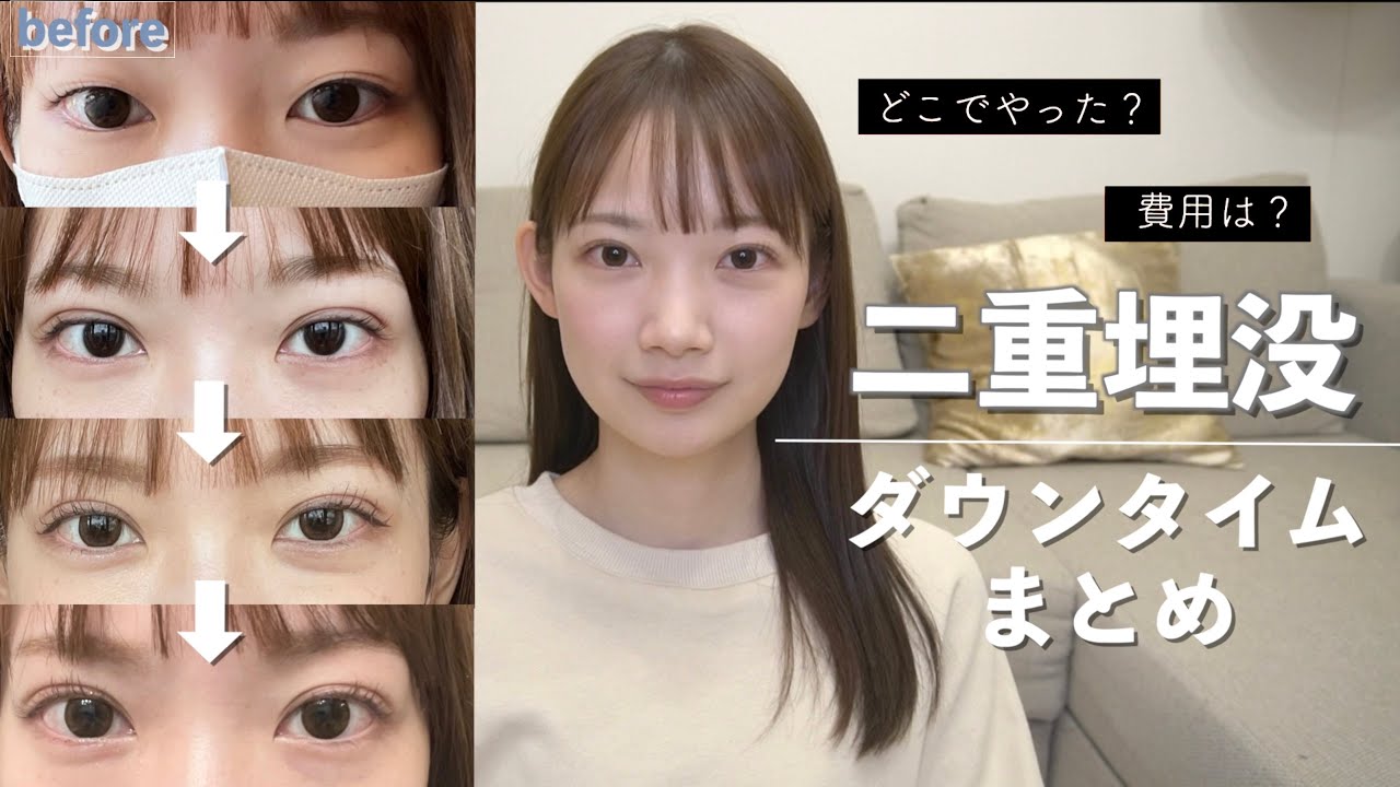 【二重埋没】ダウンタイムの様子全て見せます！10年間のアイプチ卒業👀