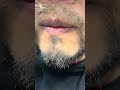 aplico el minoxidil de esta forma . rápida y sencillo Dia 100 #minoxidilbeard #Beard #minoxidil