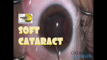 How to CATARACT SURGERY: Soft cataract in a young person w/ Softec HD lens