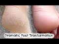 DRAMATIC FOOT TRANSFORMATION IN 10 DAYS | HOW I FIXED MY DRY, CRACKED HEELS | KERRY WHELPDALE