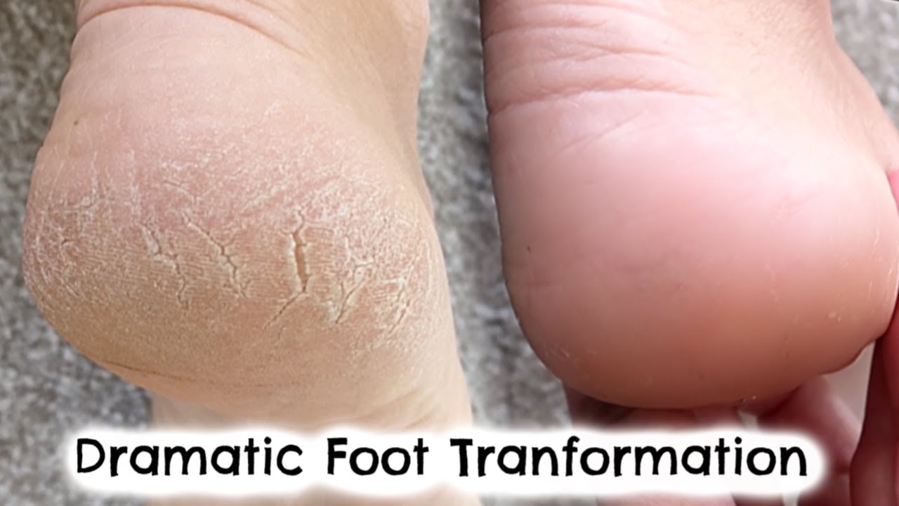 Dry Feet & Cracked Heels: Causes & Treatment - Foot and Ankle Group