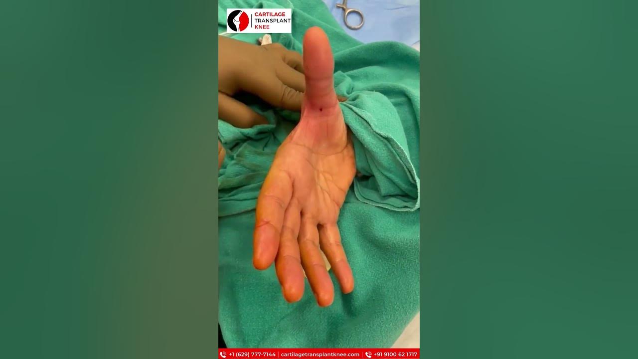 Trigger thumb release understanding the procedure and recovery youtube