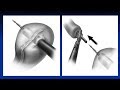 VATS IVOR LEWIS Esophagectomy MIE