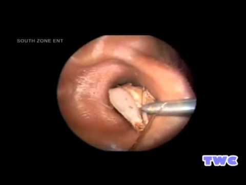 Video: Infecții Ale Urechii La Cobai