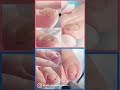 【肥厚爪】#shorts