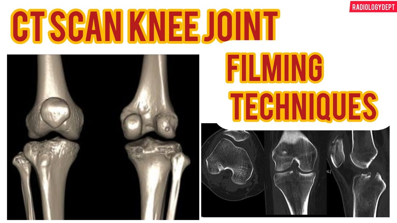 CT Scan Knee Joint Easy Filming Technique in #Hindi | CT Knee Filming # ...