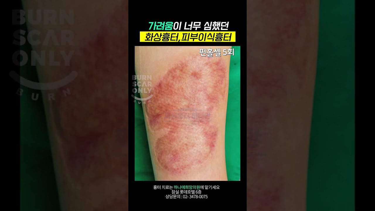 가려움이 너무 심했던 화상흉터, 피부이식흉터! 핀홀셀로 해결했습니다????