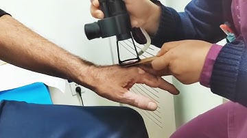 New Treatment for vitiligo 2024 _ Fractional Laser #vitiligo #laser