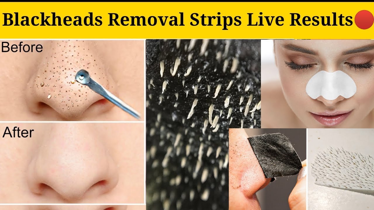 Viral Blackheads removal stripsWorked Or Not Live Results blackheads