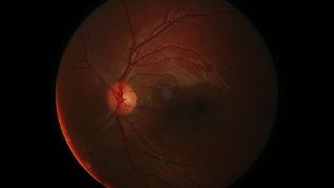 Clinically applicable deep learning for diagnosis and referral in retinal disease.