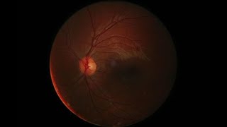 Clinically applicable deep learning for diagnosis and referral in retinal disease.