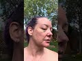 72 hrs After Face Injections #over40women #faceinjections #mature #healing