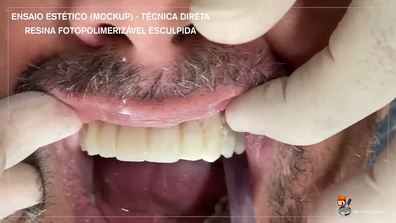 ENSAIO ESTÉTICO (MOCKUP) - TÉCNICA DIRETA DA RESINA FOTOPOLIMERIZÁVEL ESCULPIDA