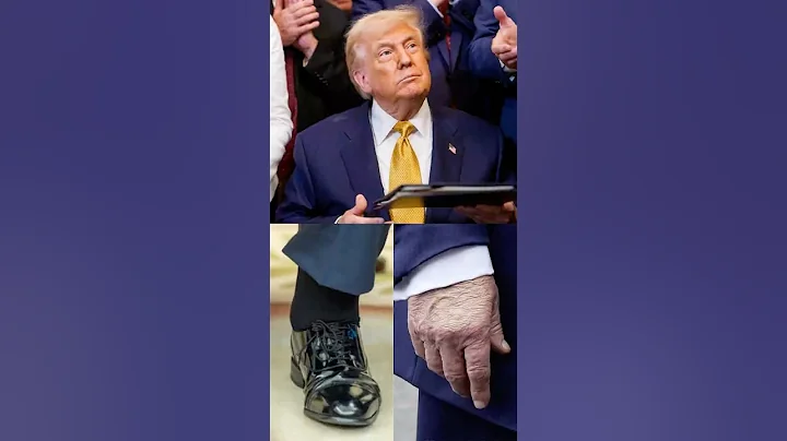 Trump Diagnosed With Chronic Venous Insufficiency