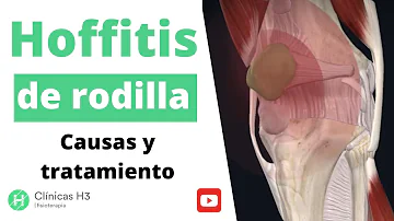 ¿Cuánto tarda en curarse la Hoffitis?