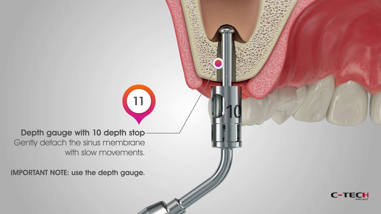 Kit Strumenti Per Rialzo Del Seno Mascellare &ndash; Medentra, Chirurgia Implantare