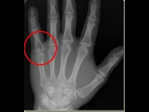 jammed finger xray