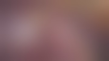 Laparoscopic anatomical liver segment II resection