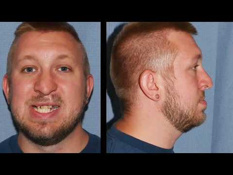 Video thumbnail: Aesthetic JAW & RHINOPLASTY for Cleft Lip and Asymmetry