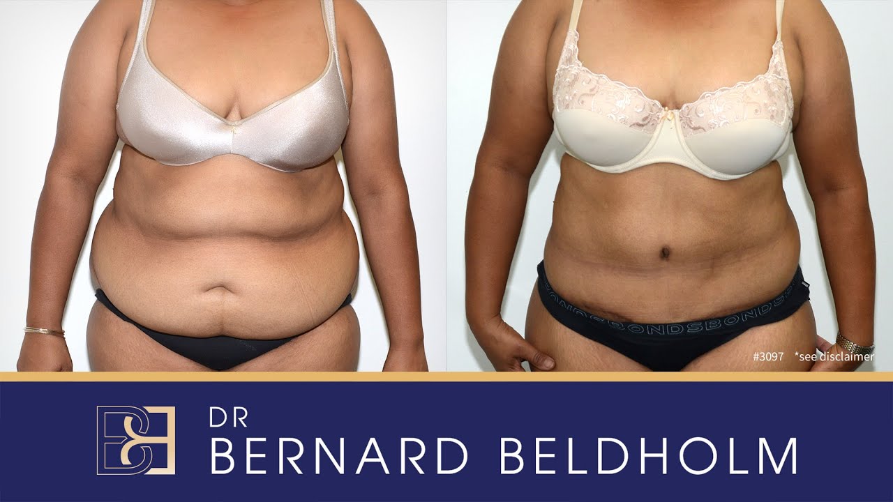 Abdominoplasty with Liposuction Removing 8kg of Weight {Patient 3097} Before & After