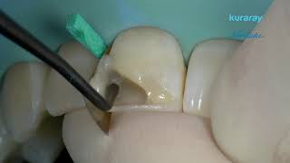 3. Stratificazione classe IV - Restauro dei denti anteriori con CLEARFIL MAJESTY ES-2