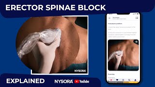 Erector Spinae Plane Block (ESP): When, How & Why by NYSORA - Education 15,398 views 6 months ago 1 minute, 16 seconds