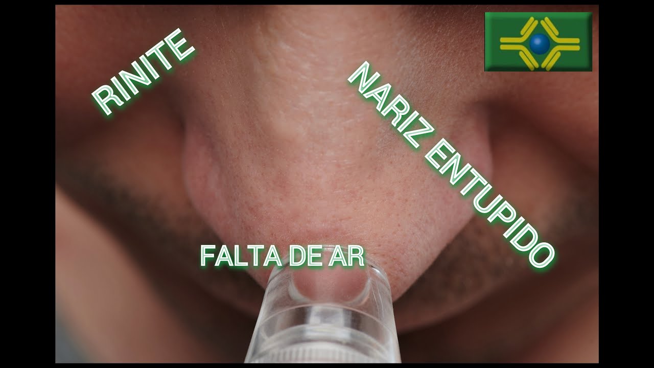 RINITE ALÉRGICA que não melhora | Nariz ENTUPIDO | vezes FALTA DE AR ...