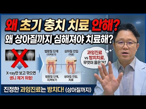 Why Do We Wait for Cavities to Get Worse Before Treating Them?