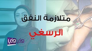 علاج متلازمة النفق الرسغي طبيعياً