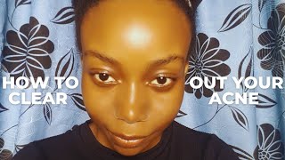 3 Causes of Acne + How to get rid of it (2026) |Easy Guide