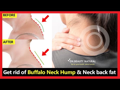 (Work 100%) How to get rid of Neck Hump, fix buffalo neck hump, fix back neck fat | 3 Easy Exercises